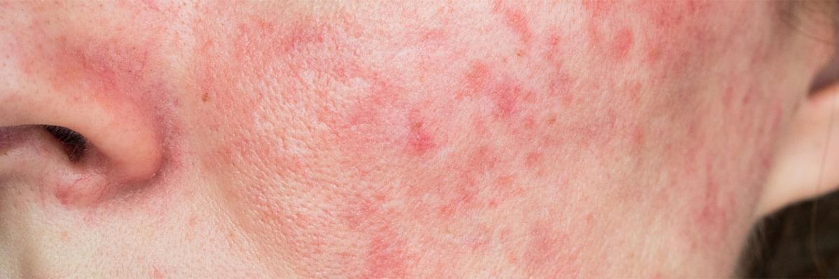 What is Rosacea?