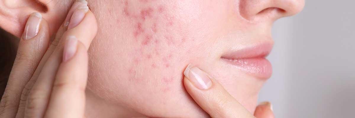 Managing Rosacea: Effective Aesthetic Treatments for Relief