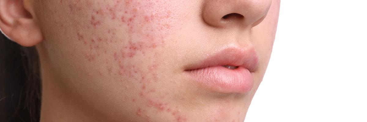 cne-prone skin care, manage acne breakouts, causes of acne, best routine for acne