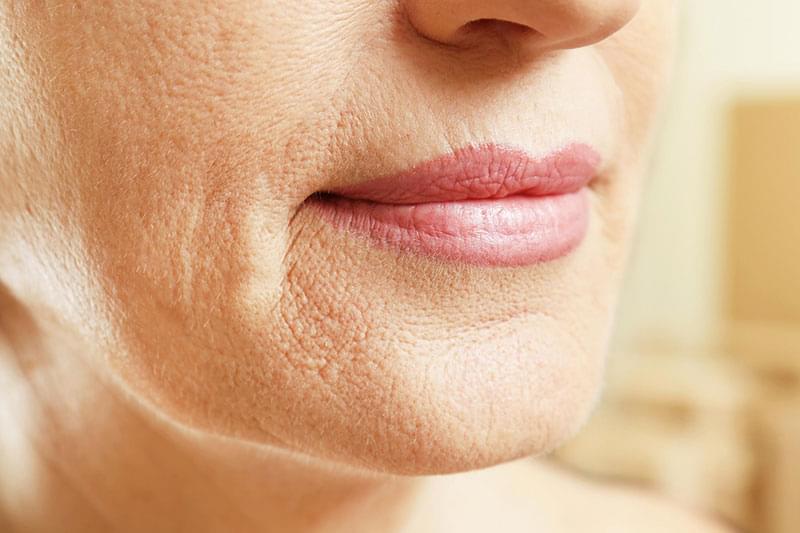 Smokers lines treatments LDR clinic Stithians, Truro, Cornwall